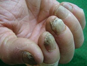 哪些是产生灰指甲的病因